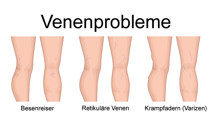 Darstellung von Venenproblemen